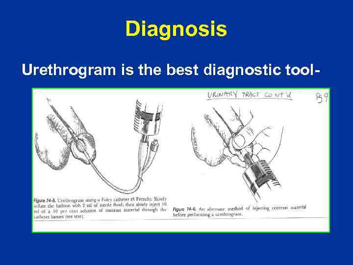 Diagnosis Urethrogram is the best diagnostic tool- 