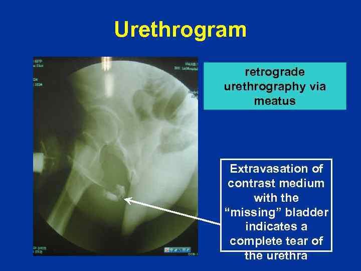 Urethrogram retrograde urethrography via meatus Extravasation of contrast medium with the “missing” bladder indicates