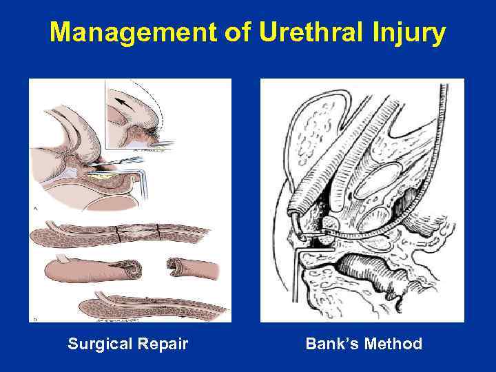 Management of Urethral Injury Surgical Repair Bank’s Method 