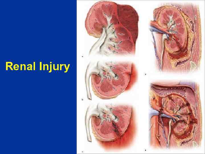 Renal Injury 