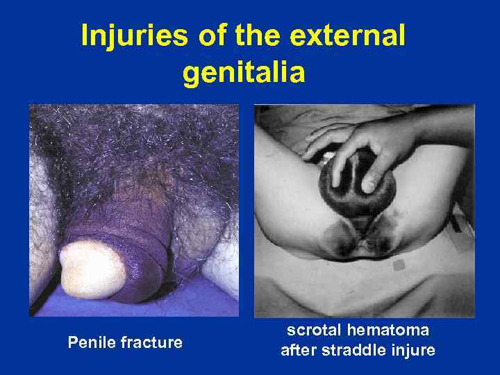 Injuries of the external genitalia Penile fracture scrotal hematoma after straddle injure 