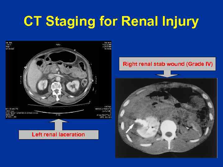 CT Staging for Renal Injury Right renal stab wound (Grade IV) Left renal laceration