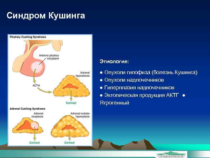 Синдром Кушинга Этиология: ● Опухоли гипофиза (болезнь Кушинга) ● Опухоли надпочечников ● Гиперплазия надпочечников