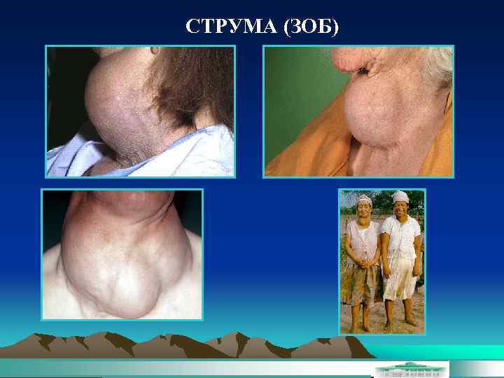 СТРУМА (ЗОБ) 