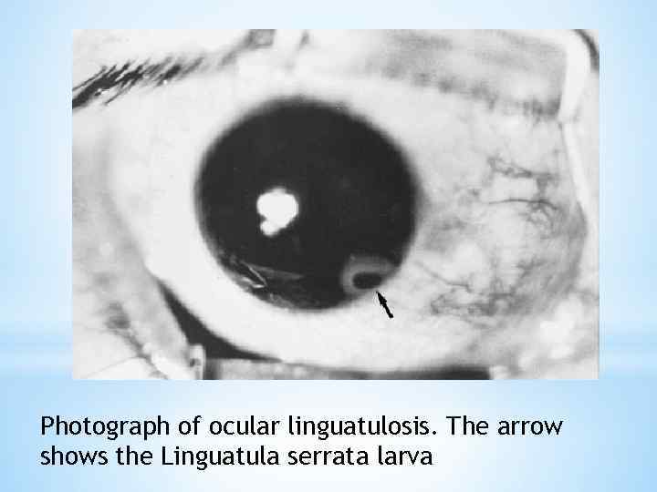 Photograph of ocular linguatulosis. The arrow shows the Linguatula serrata larva 