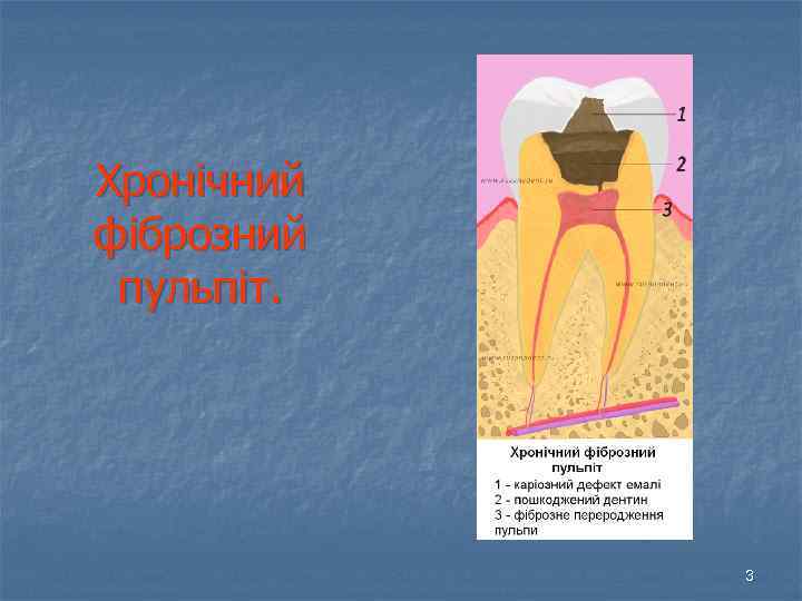 Хронічний фіброзний пульпіт. 3 
