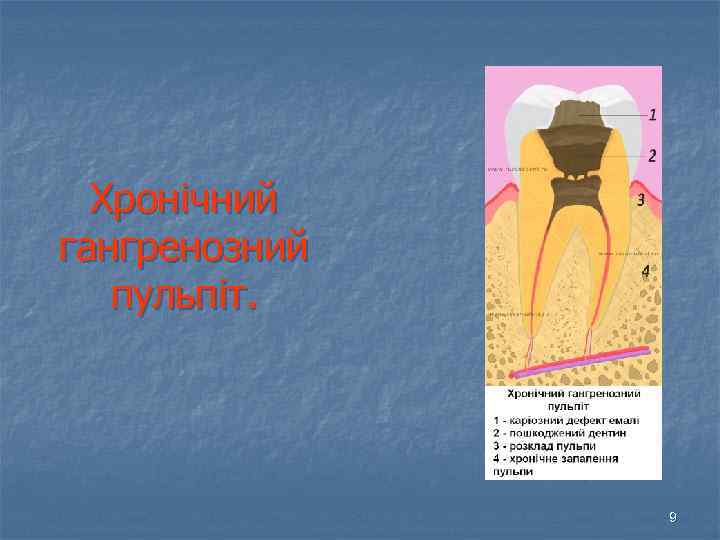 Хронічний гангренозний пульпіт. 9 