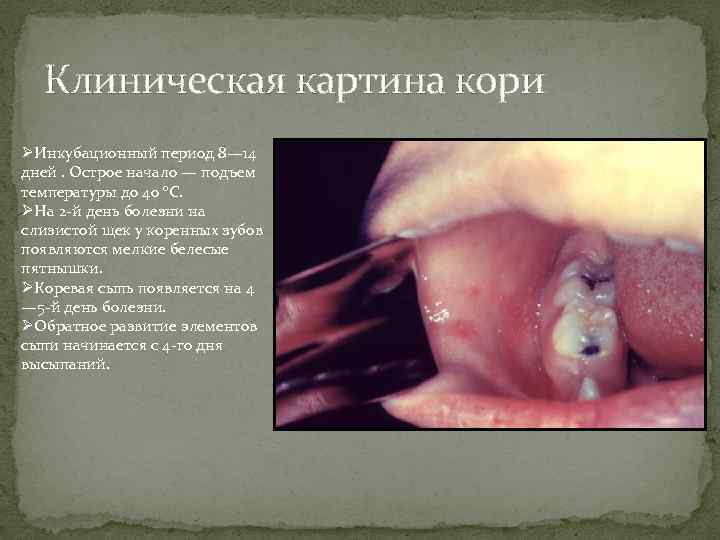 Клиническая картина кори ØИнкубационный период 8— 14 дней. Острое начало — подъем температуры до