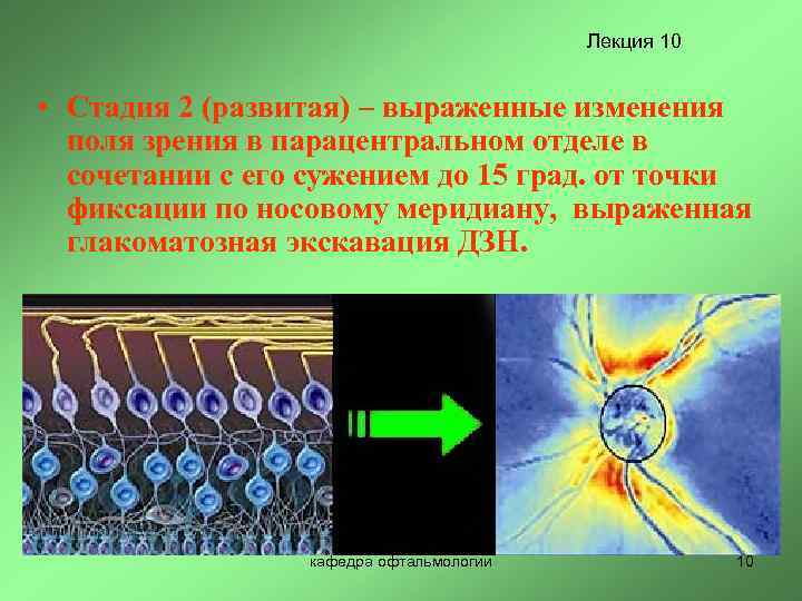 Лекция 10 • Стадия 2 (развитая) – выраженные изменения поля зрения в парацентральном отделе