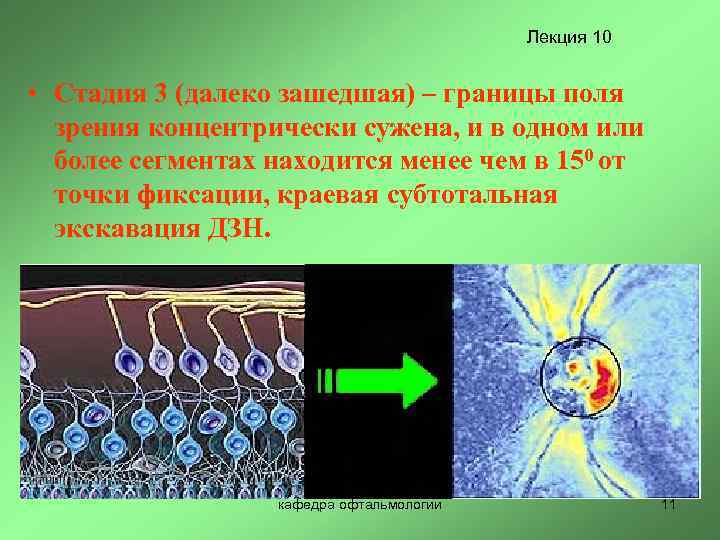 Лекция 10 • Стадия 3 (далеко зашедшая) – границы поля зрения концентрически сужена, и