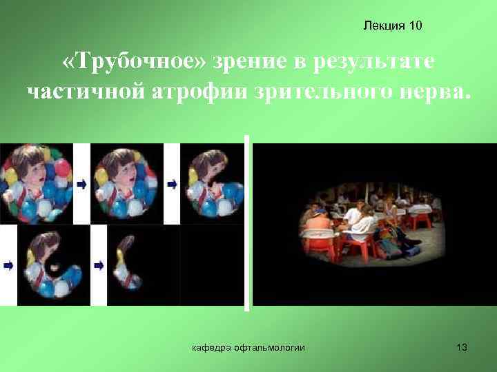 Лекция 10 «Трубочное» зрение в результате частичной атрофии зрительного нерва. кафедра офтальмологии 13 