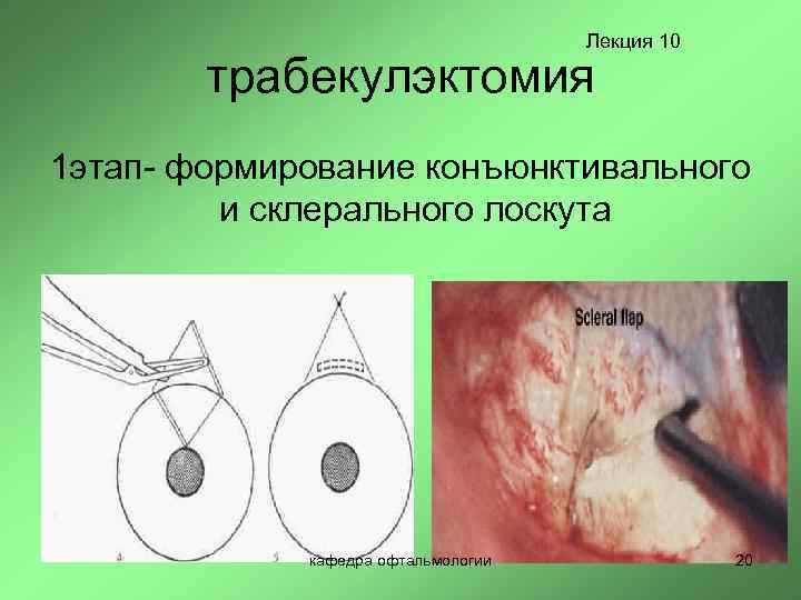 Лекция 10 трабекулэктомия 1 этап- формирование конъюнктивального и склерального лоскута кафедра офтальмологии 20 