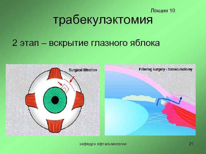 Лекция 10 трабекулэктомия 2 этап – вскрытие глазного яблока кафедра офтальмологии 21 