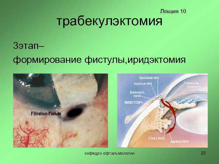 Лекция 10 трабекулэктомия 3 этап– формирование фистулы, иридэктомия кафедра офтальмологии 22 