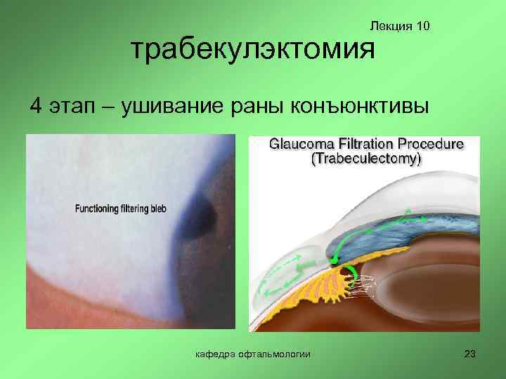 Лекция 10 трабекулэктомия 4 этап – ушивание раны конъюнктивы кафедра офтальмологии 23 