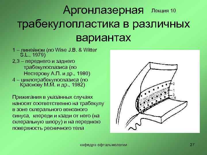 Аргонлазерная Лекция 10 трабекулопластика в различных вариантах 1 – линейном (по Wise J. B.