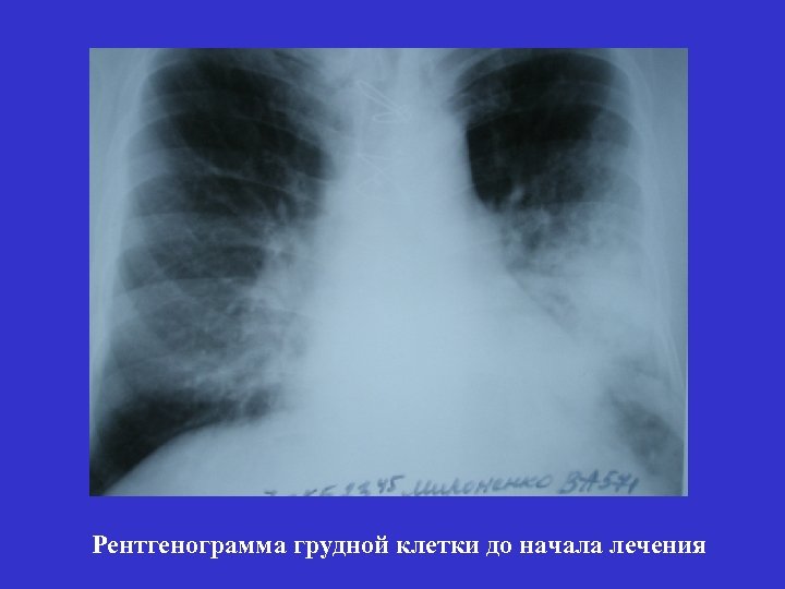 Рентгенограмма грудной клетки до начала лечения 