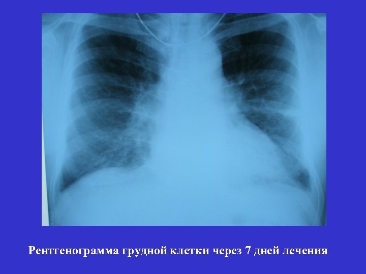 Рентгенограмма грудной клетки через 7 дней лечения 