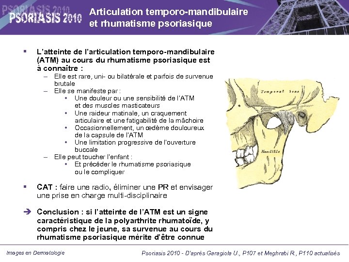 Articulation temporo-mandibulaire et rhumatisme psoriasique L’atteinte de l’articulation temporo-mandibulaire (ATM) au cours du rhumatisme