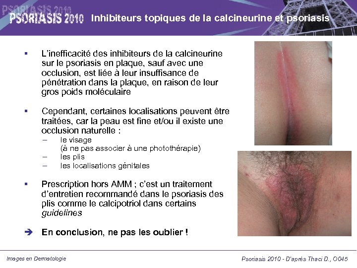 Inhibiteurs topiques de la calcineurine et psoriasis L’inefficacité des inhibiteurs de la calcineurine sur