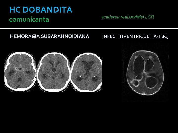 HC DOBANDITA comunicanta scaderea reabsorbtiei LCR HEMORAGIA SUBARAHNOIDIANA INFECTII (VENTRICULITA-TBC) 