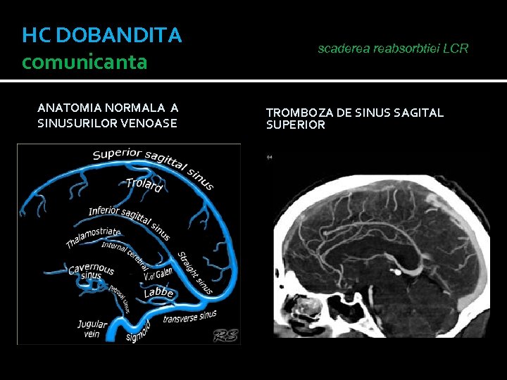 HC DOBANDITA comunicanta ANATOMIA NORMALA A SINUSURILOR VENOASE scaderea reabsorbtiei LCR TROMBOZA DE SINUS