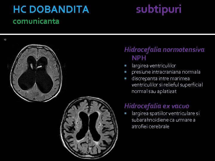 HC DOBANDITA subtipuri comunicanta Hidrocefalia normotensiva NPH largirea ventriculilor presiune intracraniana normala discrepanta intre