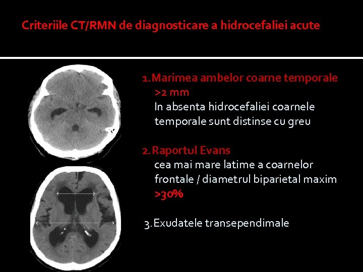 Criteriile CT/RMN de diagnosticare a hidrocefaliei acute 1. Marimea ambelor coarne temporale >2 mm