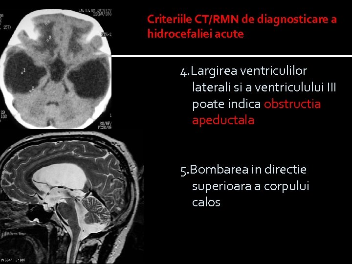 Criteriile CT/RMN de diagnosticare a hidrocefaliei acute 4. Largirea ventriculilor laterali si a ventriculului