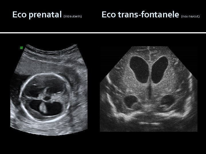 Eco prenatal (intrauterin) Eco trans-fontanele (nou nascut) 