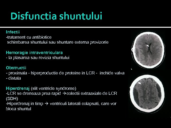 Disfunctia shuntului Infectii -tratament cu antibiotice schimbarea shuntului sau shuntare externa provizorie Hemoragie intraventriculara