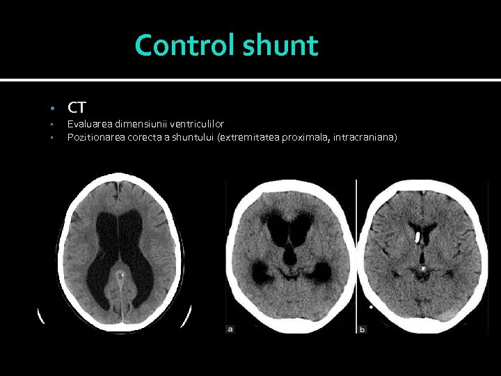 Control shunt • • • CT Evaluarea dimensiunii ventriculilor Pozitionarea corecta a shuntului (extremitatea