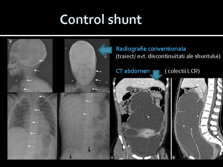 Control shunt Radiografie conventionala (traiect/ evt. discontinuitati ale shuntului) CT abdomen ( colectii LCR)