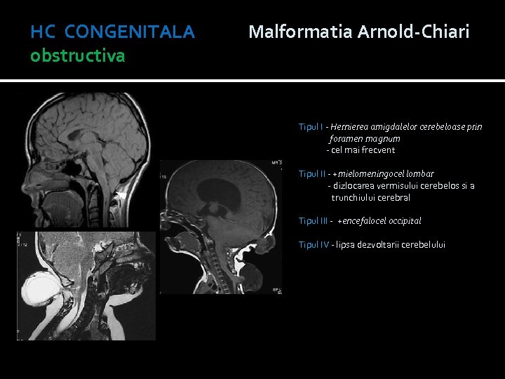 HC CONGENITALA Malformatia Arnold-Chiari obstructiva Tipul I - Hernierea amigdalelor cerebeloase prin foramen magnum