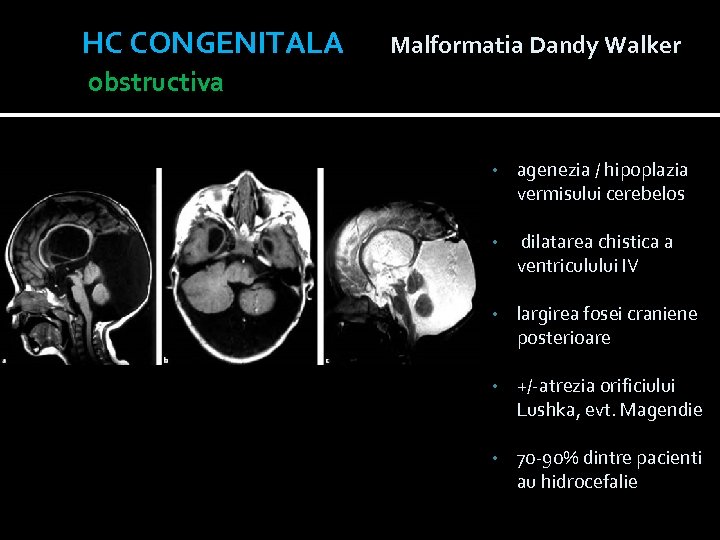 HC CONGENITALA Malformatia Dandy Walker obstructiva • agenezia / hipoplazia vermisului cerebelos • dilatarea