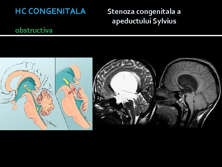 HC CONGENITALA Stenoza congenitala a apeductului Sylvius obstructiva NORMAL STENOZA DE APEDUCT OBLITERAT APEDUCT