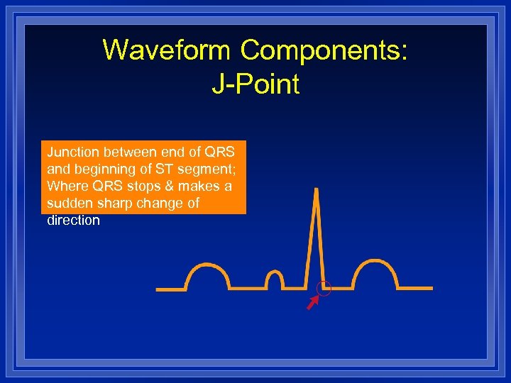 Waveform Components: J-Point Junction between end of QRS and beginning of ST segment; Where