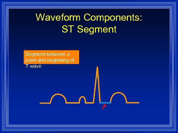 Waveform Components: ST Segment between Jpoint and beginning of T wave 