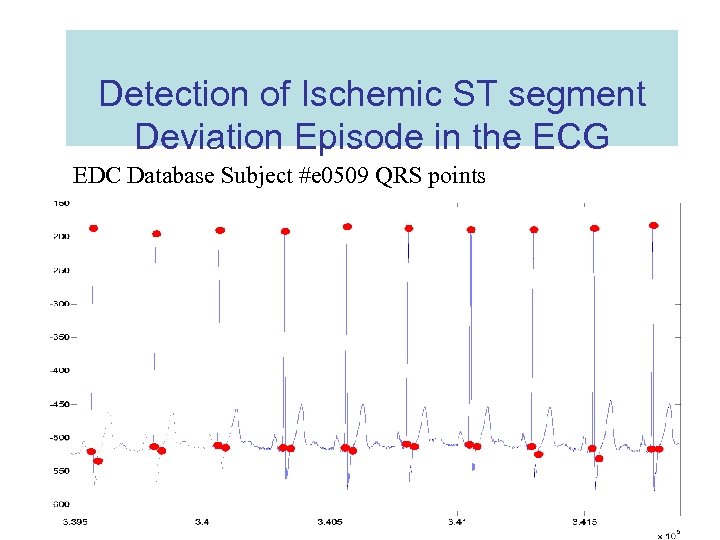 Detection of Ischemic ST segment Deviation Episode in the ECG EDC Database Subject #e