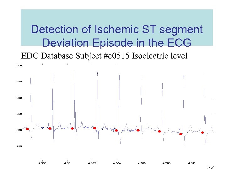 Detection of Ischemic ST segment Deviation Episode in the ECG EDC Database Subject #e