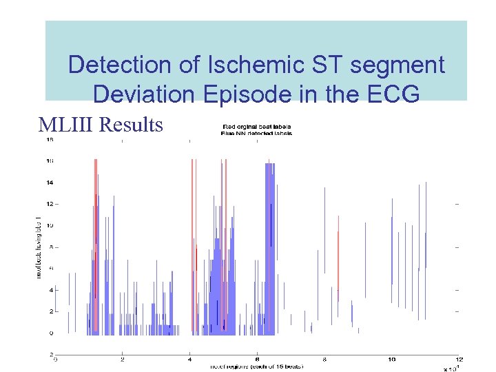 Detection of Ischemic ST segment Deviation Episode in the ECG MLIII Results 
