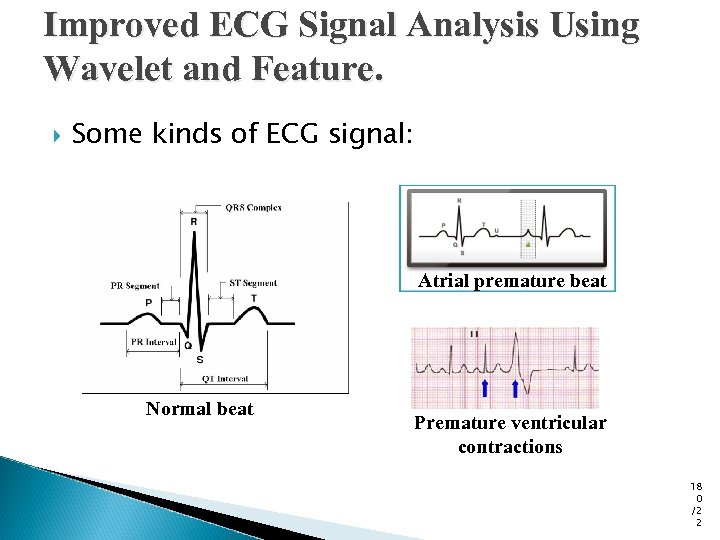 Improved ECG Signal Analysis Using Wavelet and Feature. Some kinds of ECG signal: Atrial