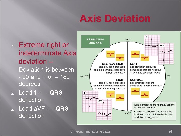Axis Deviation Extreme right or indeterminate Axis deviation – Deviation is between - 90