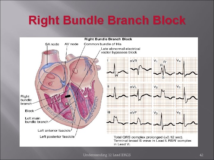 Right Bundle Branch Block Understanding 12 Lead EKGS 42 