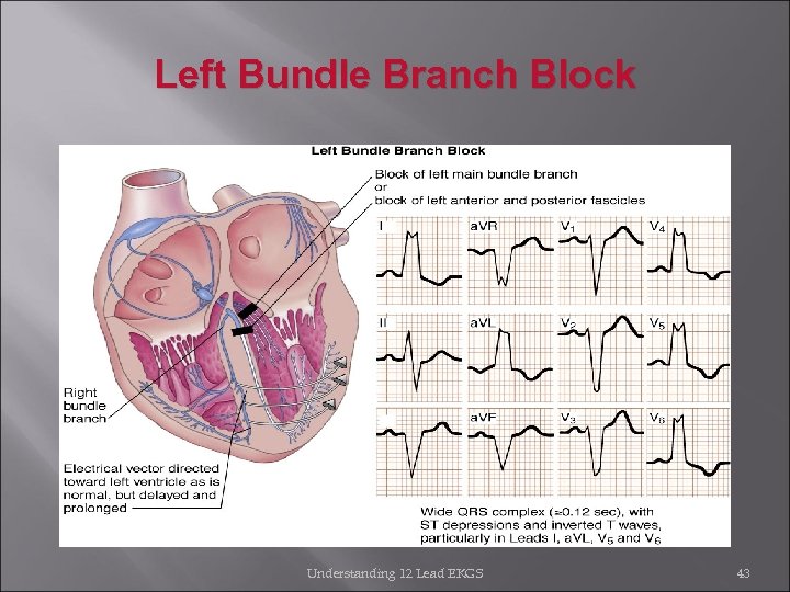 Left Bundle Branch Block Understanding 12 Lead EKGS 43 