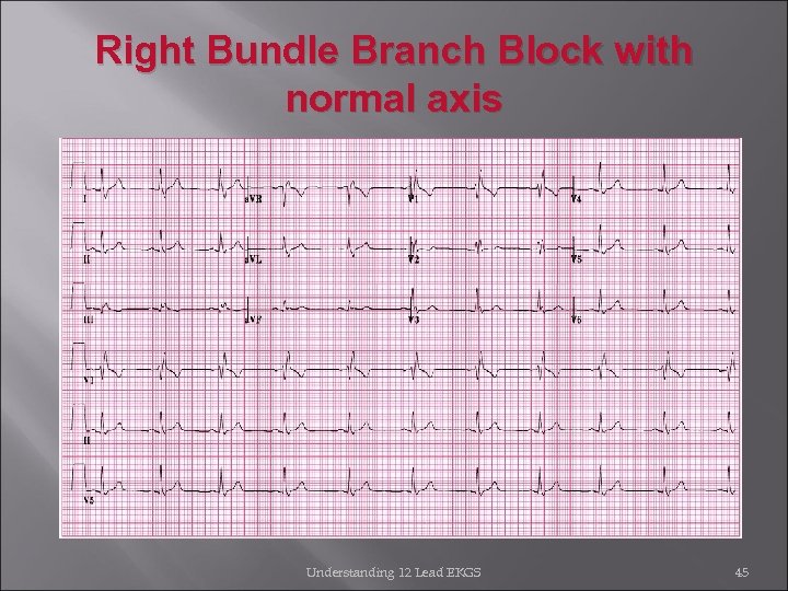 Right Bundle Branch Block with normal axis Understanding 12 Lead EKGS 45 