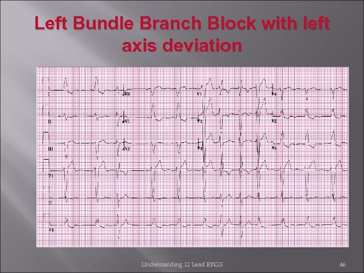 Left Bundle Branch Block with left axis deviation Understanding 12 Lead EKGS 46 