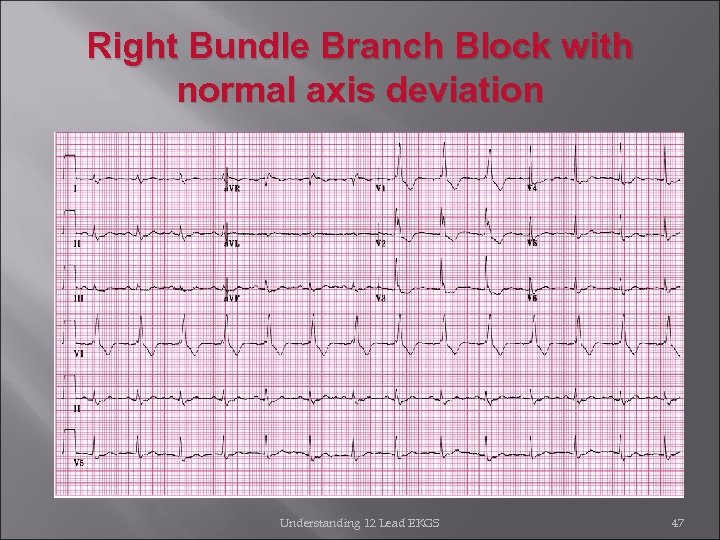Right Bundle Branch Block with normal axis deviation Understanding 12 Lead EKGS 47 