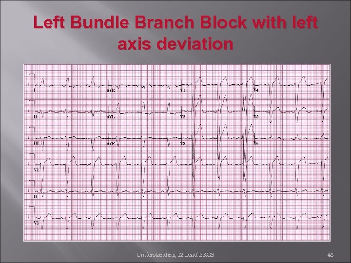 Left Bundle Branch Block with left axis deviation Understanding 12 Lead EKGS 48 