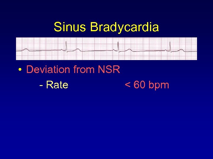 Sinus Bradycardia • Deviation from NSR - Rate < 60 bpm 